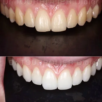 Quel type de blanchiment dentaire choisir sans risque pour mes dents