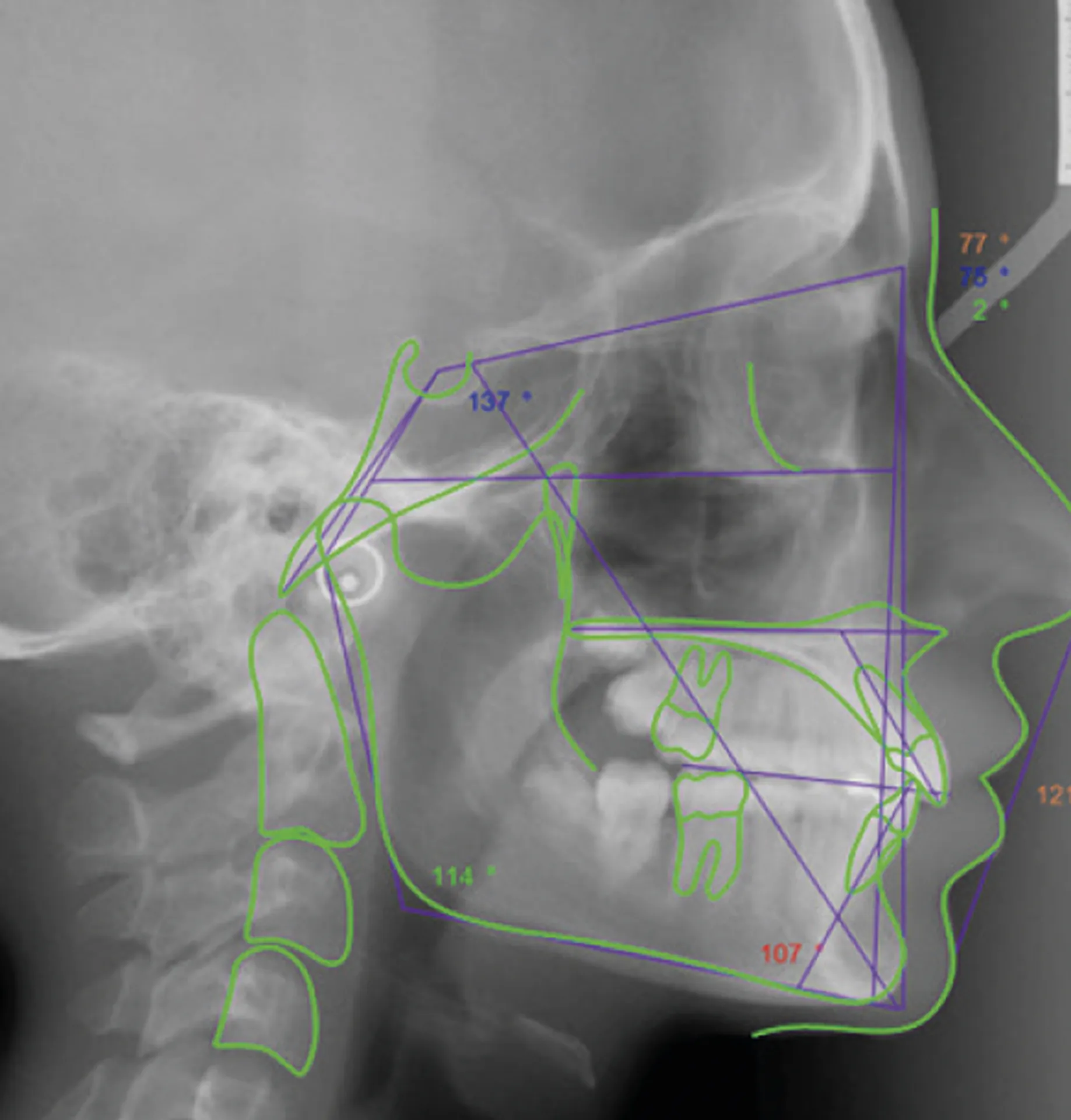 Owandy CEPH ANALYSIS