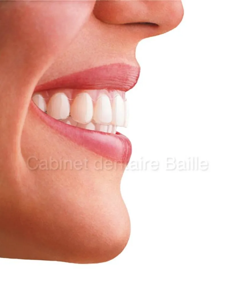 invisalign cabinet dentaire baille