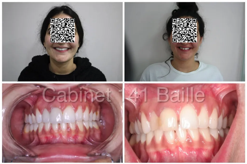 cas invisalign avant Après  marseille 