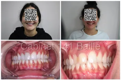 cas invisalign avant Après  marseille 