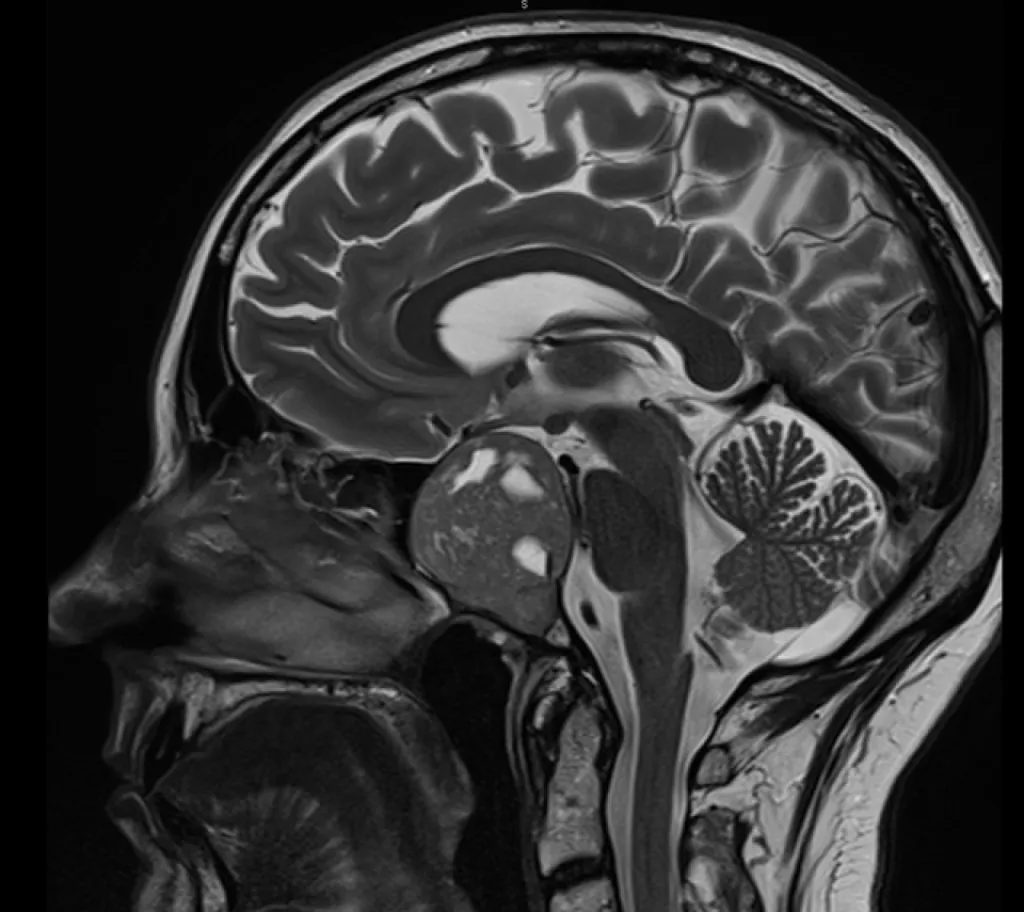 Adénome hypophysaire