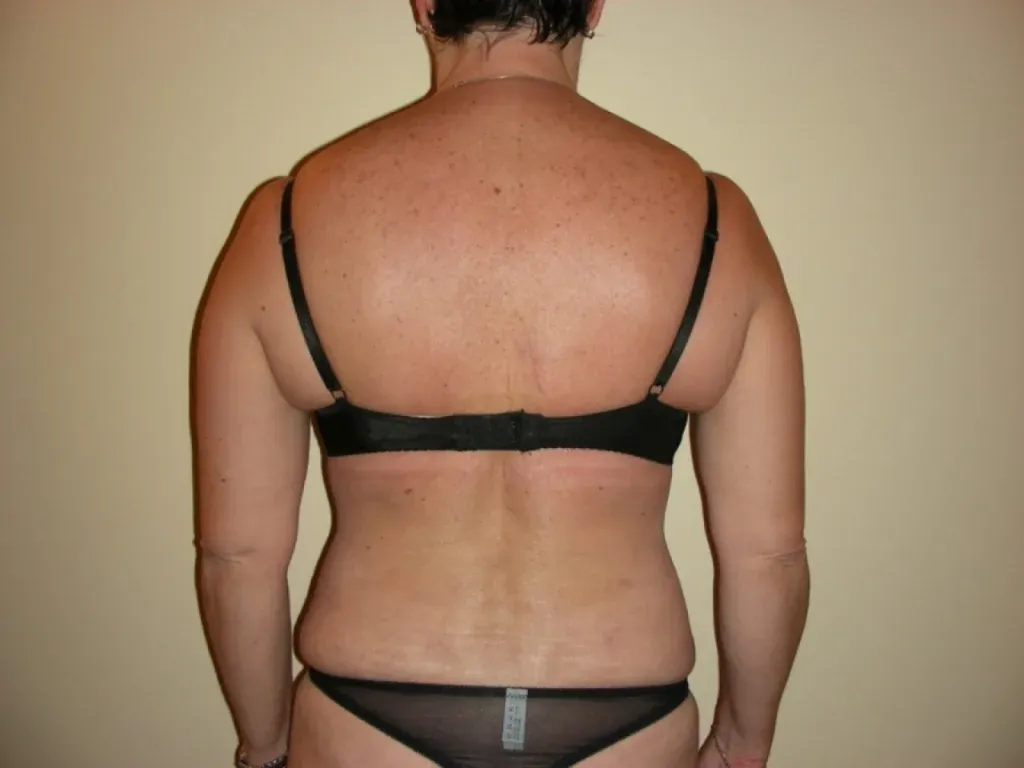 Body lift surgery in France: Dr Jean-François Pascal’s expertise in Lyon