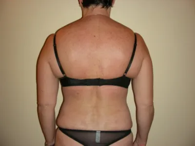 Body lift surgery in France: Dr Jean-François Pascal’s expertise in Lyon