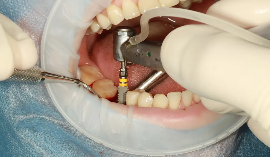 Urgence dentaire pour remplacer toutes mes dents en une journée Marseille Saint André Vous avez une urgence dentaire dû à une infection dentaire ?