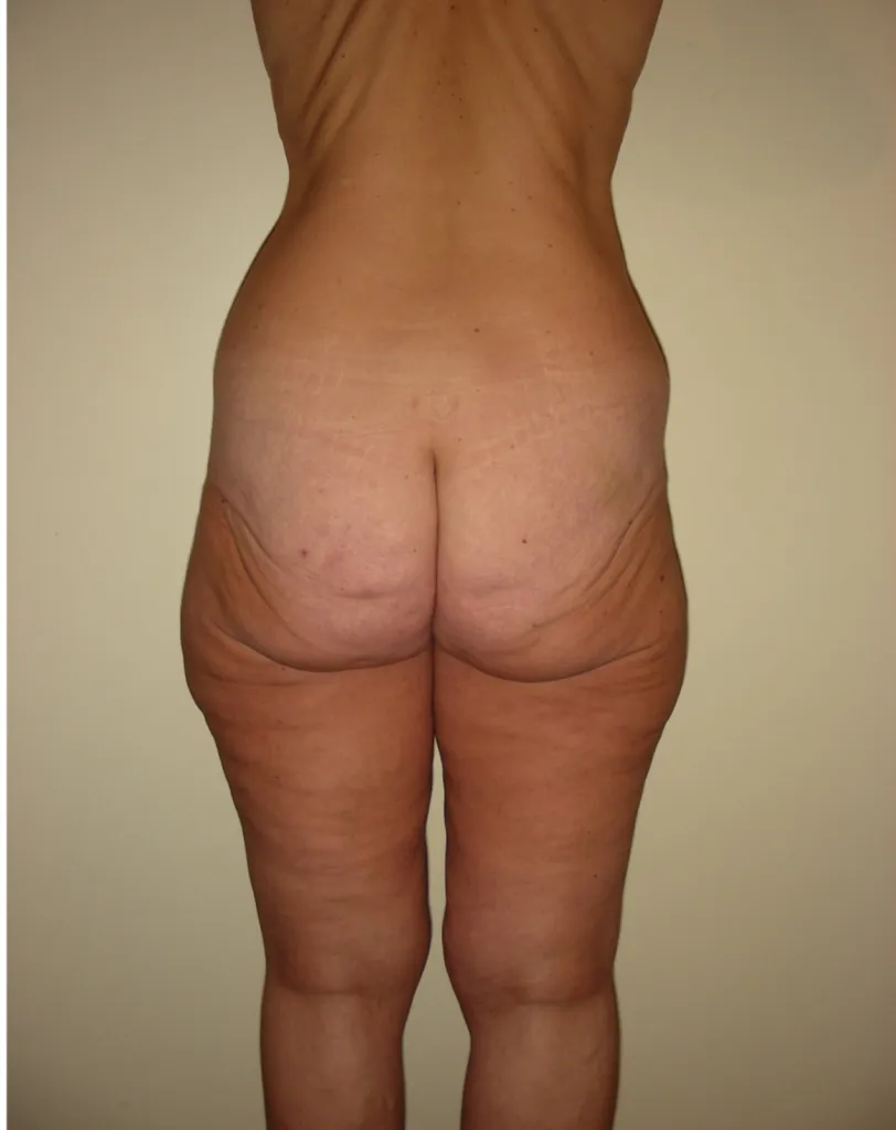 Upper body lift in France: advanced post-weight loss surgery with Dr Jean-François Pascal in Lyon