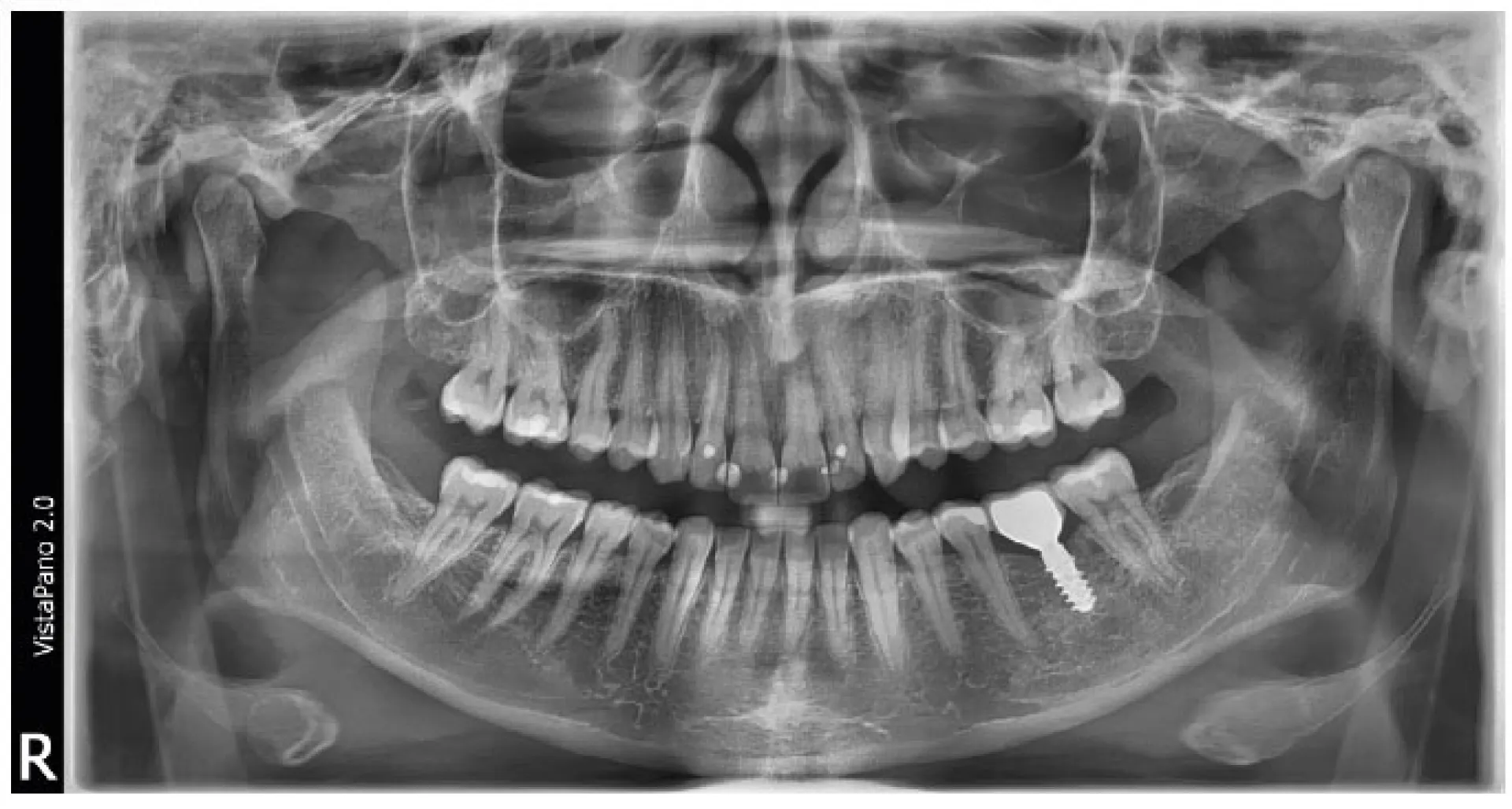 Panoramique 2D Durr Dental VistaPano