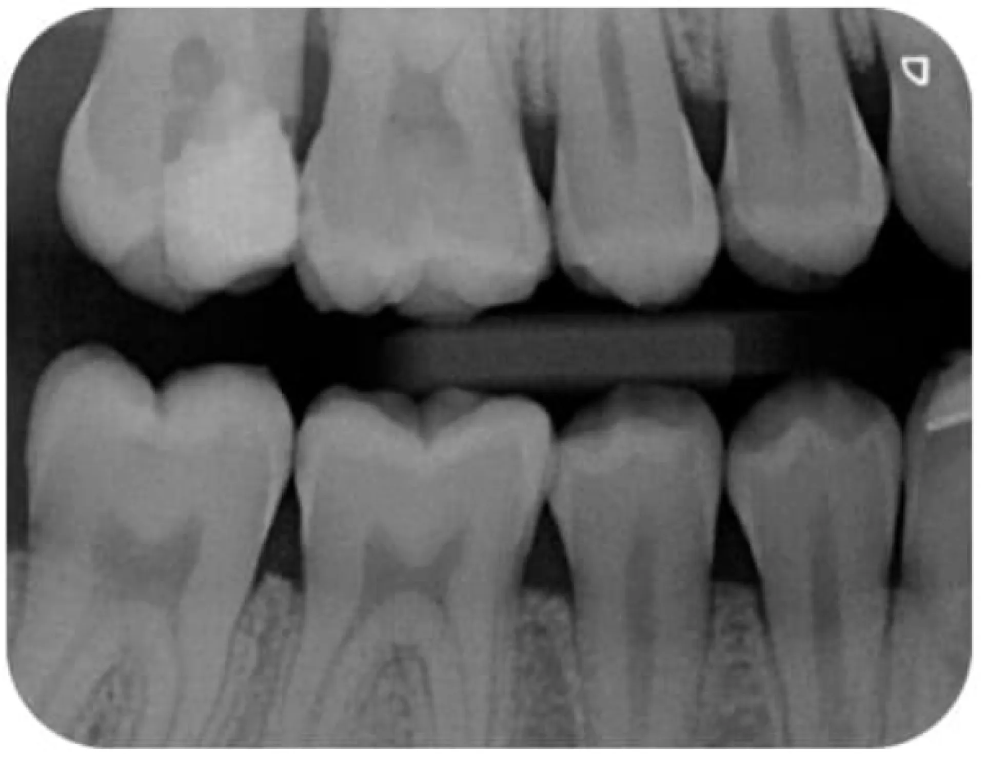 Durr Dental rétro alvéolaire