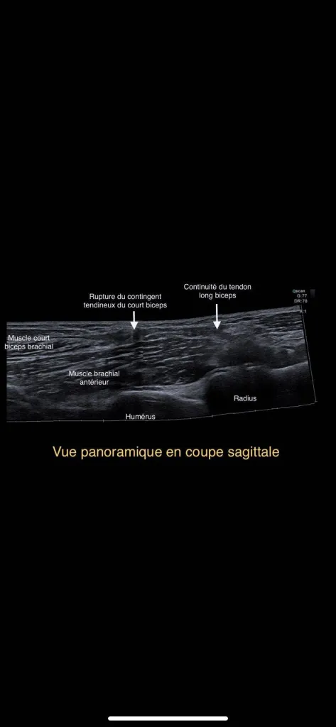 Echographie rue de Lodi : Perte de force de l'avant-bras
