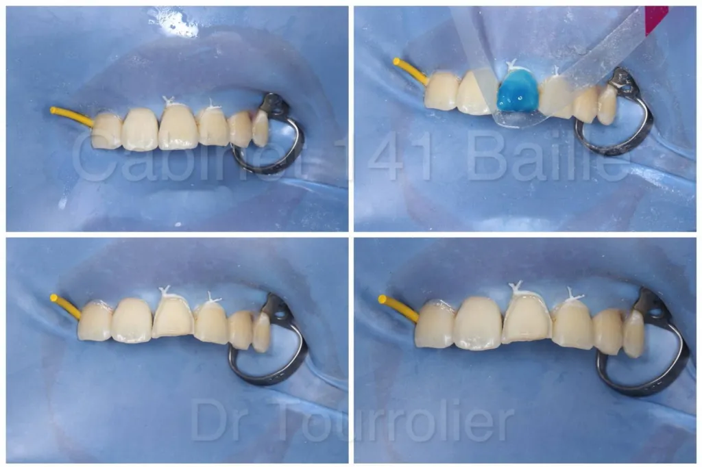 Cabinet spécialisé dans les facettes dentaires céramiques sur Marseille 13005