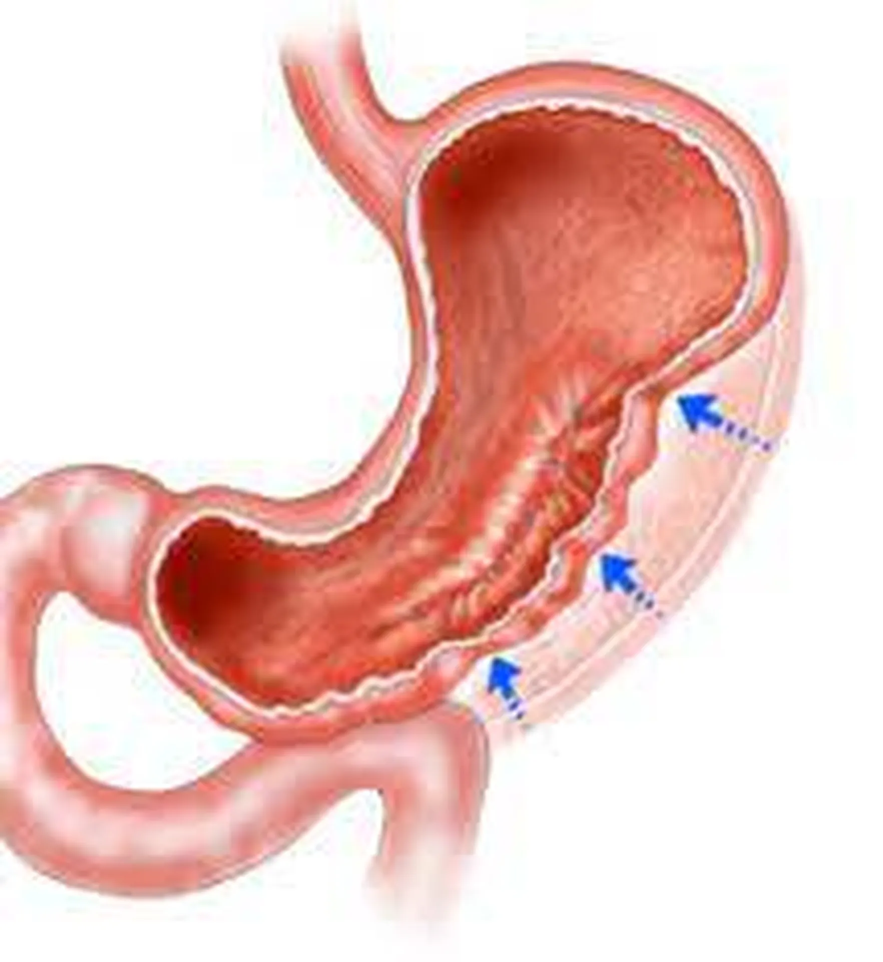 endosleeve Var toulon