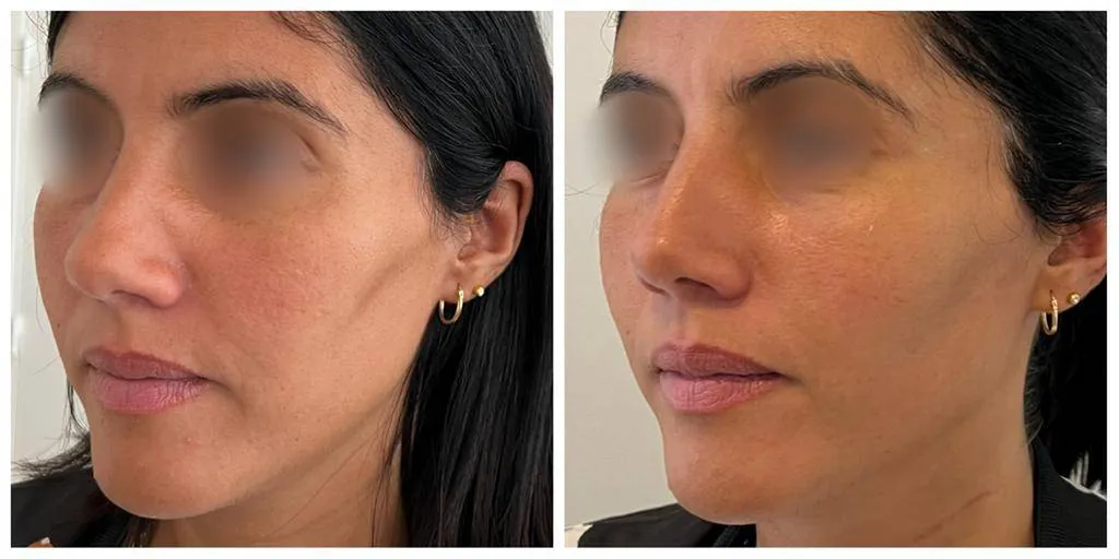 skinbooster Paris, Restylane, PDRN, acide hyaluronique Paris