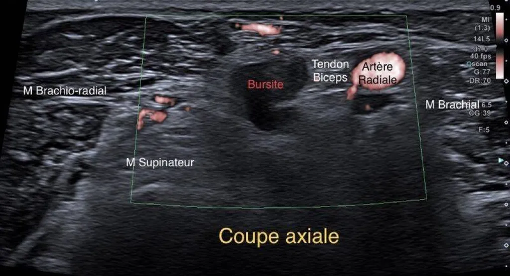 Echographie à la Rose : douleur du coude chez un employé du batiment.