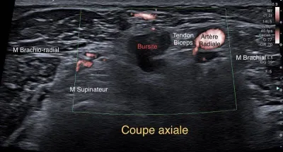 Echographie à la Rose : douleur du coude chez un employé du batiment.