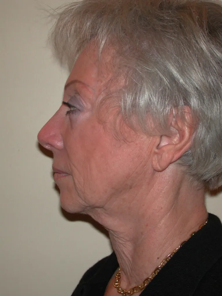 Cervico-facial facelift in France: natural and elegant results with Dr Jean-François Pascal in Lyon