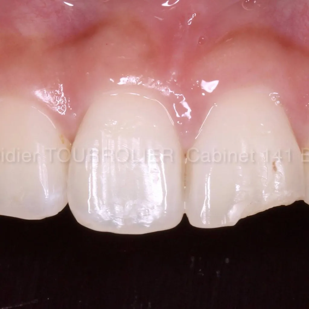 dentsite qui est spécialisé dans la pose de facettes dentaires à marseille