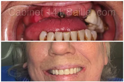 mise en charge immédiate des implants a marseille