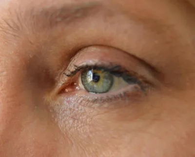 Atténuer rides et ridules autour des yeux grâce à la radiofréquence visage, l’Hydralift et une routine Skin Care au centre DERMA SUD Toulouse Haute-Garonne