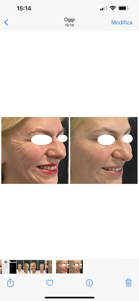 toxine botulique botox Paris 6 médecine esthétique azzalure
