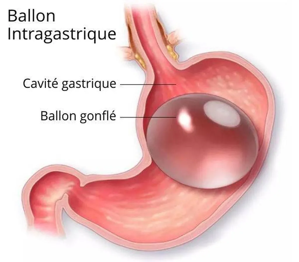 Association des médicaments pour perdre du poids et le ballon gastrique.