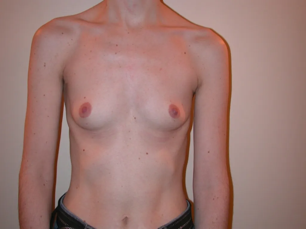 Breast augmentation in France: international expertise of Dr Jean-François Pascal in Lyon