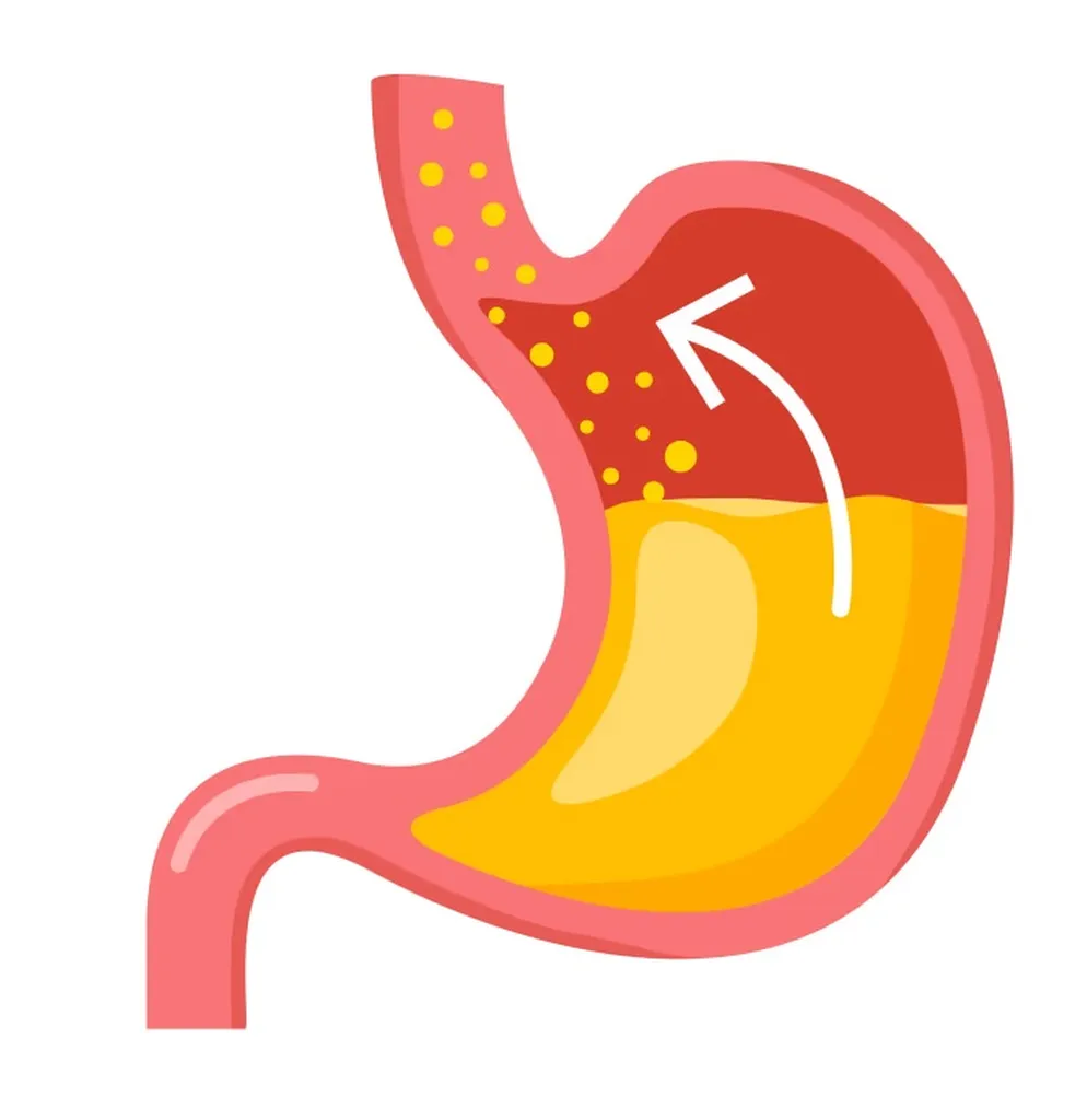 Traitement du reflux gastro-œsophagien par chirurgie mini-invasive à Marseille 8ème