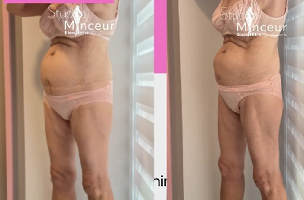 Les cellules graisseuses cristallisées sont éliminées naturellement par le corps