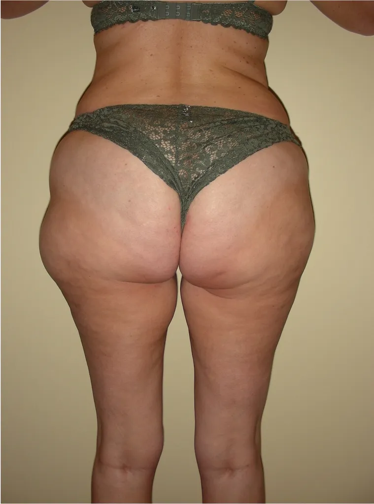 Chirurgie réparatrice extrême à Lyon – Super Bodylift & Remodelage corporel post‑amaigrissement