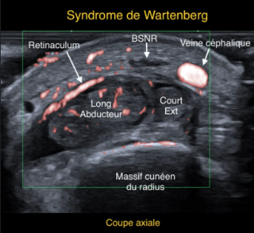 Echographie du Dome : Patient adressé pour impotence fonctionnelle du pouce avec fourmillement sur la face dorsale du 1er espace de la main et de la base du pouce.