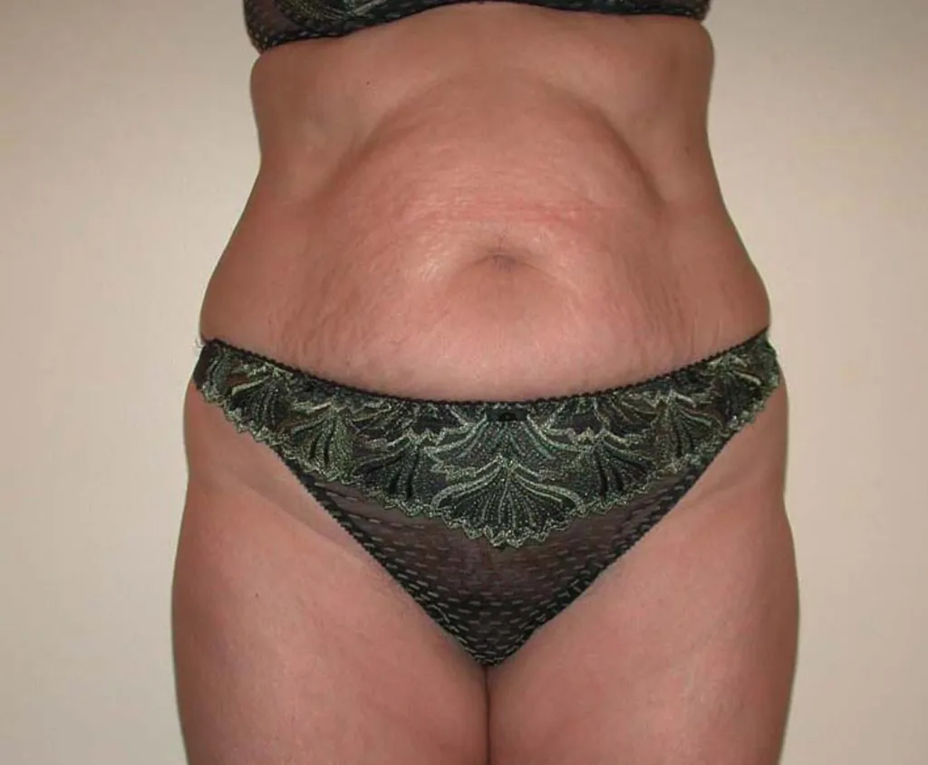 Mega-liposuction in France: international expertise with Dr Jean-François Pascal in Lyon