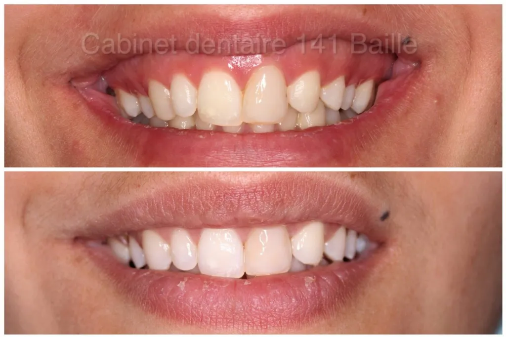 Sourire gingival Marseille traitement Invisalign 
