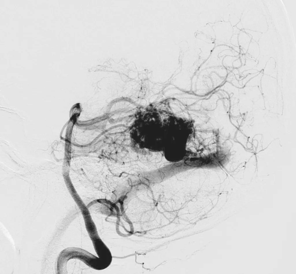 Malformation arterio-veineuse (angiome) cérébelleuse