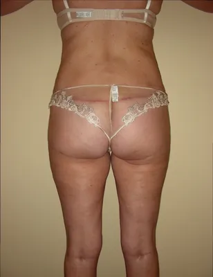 Chirurgie réparatrice extrême à Lyon – Super Bodylift & Remodelage corporel post‑amaigrissement