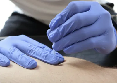 Dry needling et électroponction