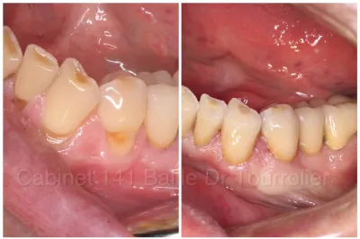 Facettes dentaires en céramique collées et greffe de gencive à Marseille