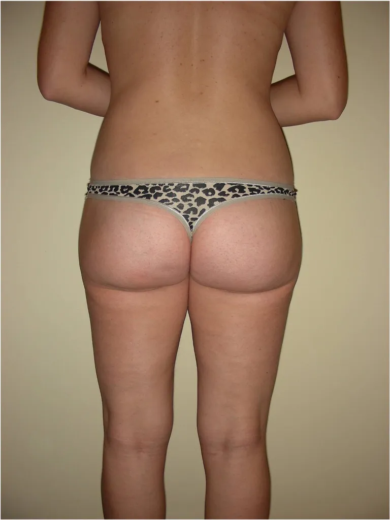 Buttock Lift & Augmentation – Top aesthetic surgeon in Lyon, France for natural curves