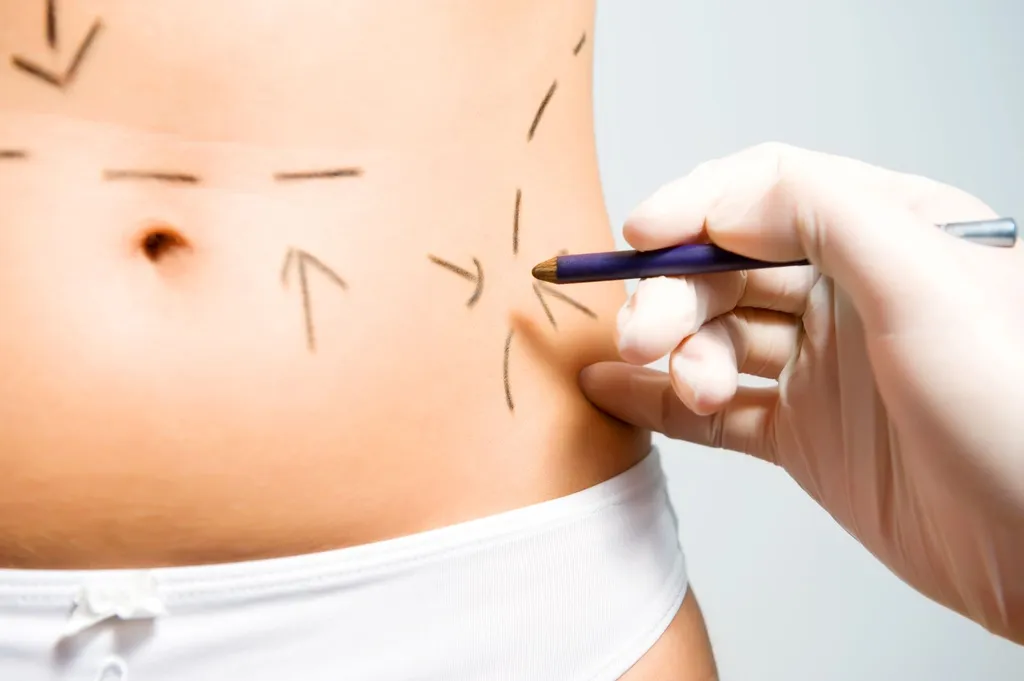Cryolipolyse ou liposuccion : quelle solution choisir pour traiter les graisses localisées sans chirurgie à Toulouse