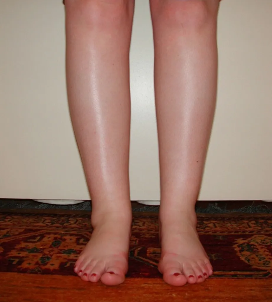 Calf and ankle liposuction in France: Dr Jean-François Pascal’s expertise in Lyon