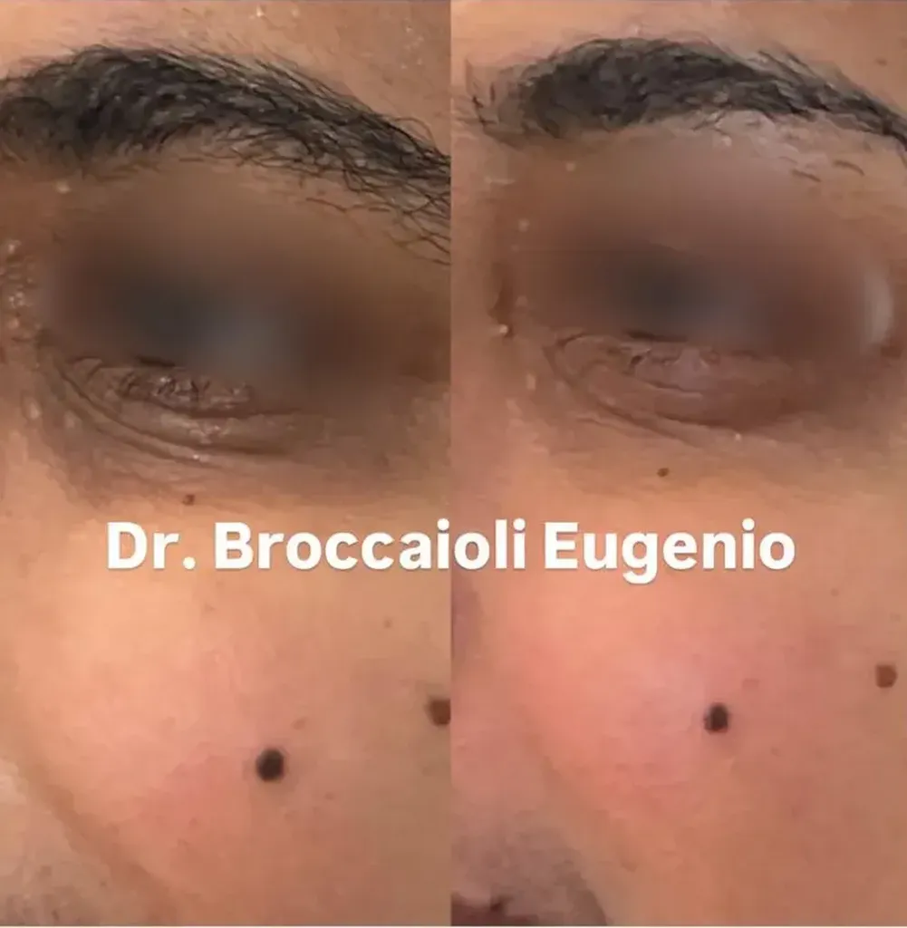 Juvelook Paris 6, acide polylactique hybride PDLLA, régénération collagène visage, bio-stimulation cutanée Boulevard Raspail