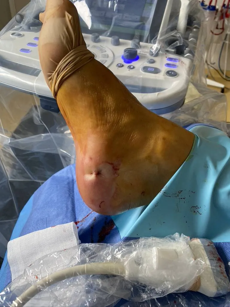 Echo-chirurgie, par le Docteur Julien Beldame, d'une aponévrosite plantaire, avec la méthode Walant 