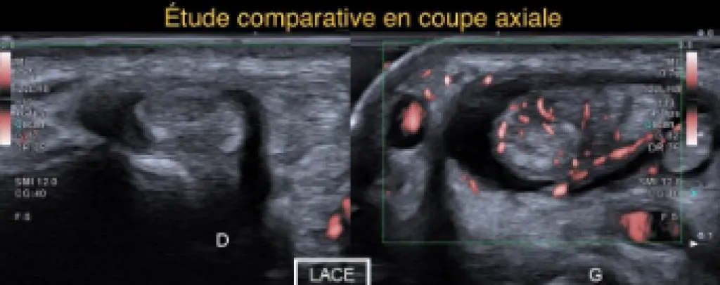 Echographie du Dome : Patient adressé pour impotence fonctionnelle du pouce avec fourmillement sur la face dorsale du 1er espace de la main et de la base du pouce.