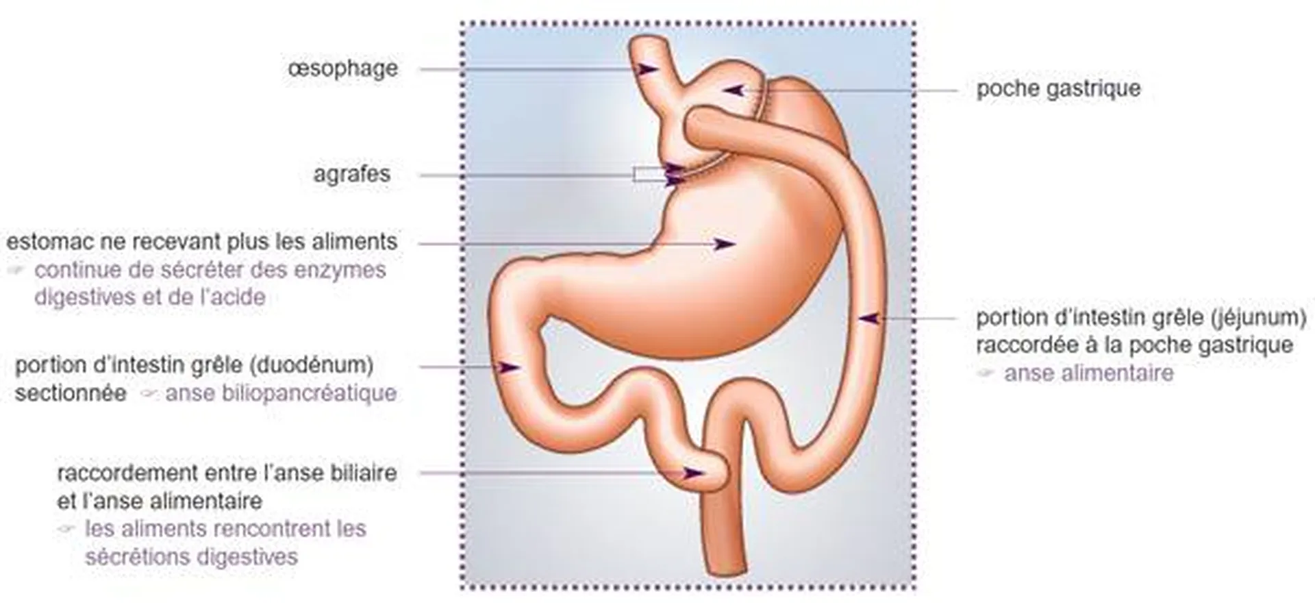 Chirurgie By pass Obésité Toulon
