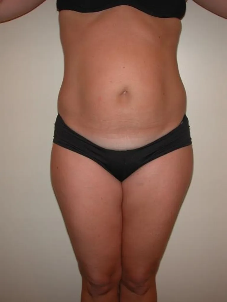 Plastie abdominale : Une réparation du ventre