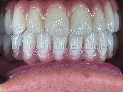 Contrôle implants All-on-6 par spécialiste implantologue à Marseille