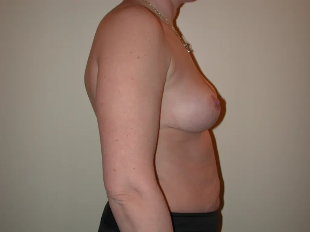 Breast lift surgery in France: Dr Jean-François Pascal’s expertise in Lyon