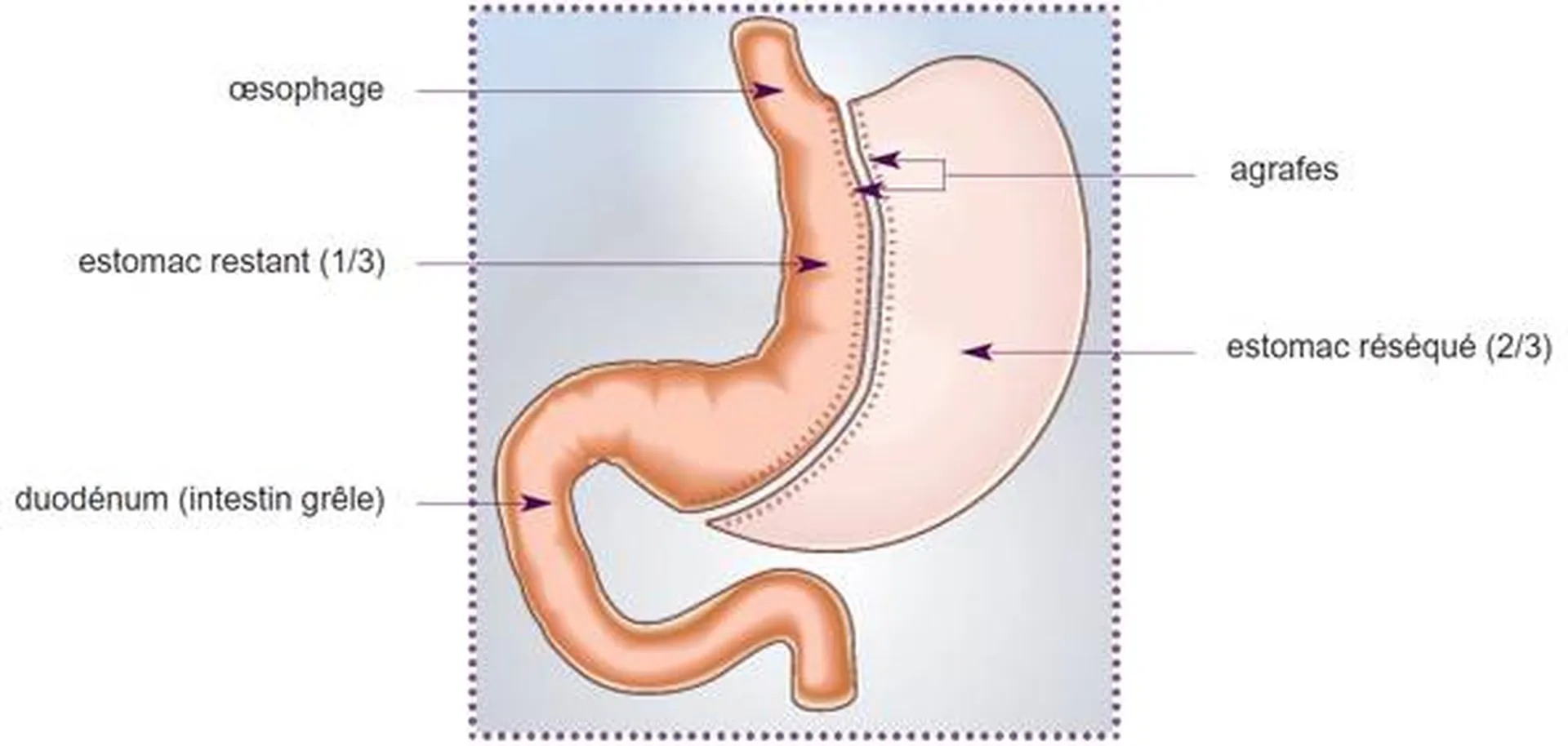 Chirurgie sleeve gastrectomie la seyne sur mer