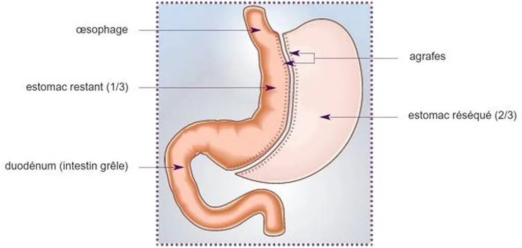 Notre zone d'activité pour ce serviceGaster Control : pour qui il est indiqué et résultats avant/après
