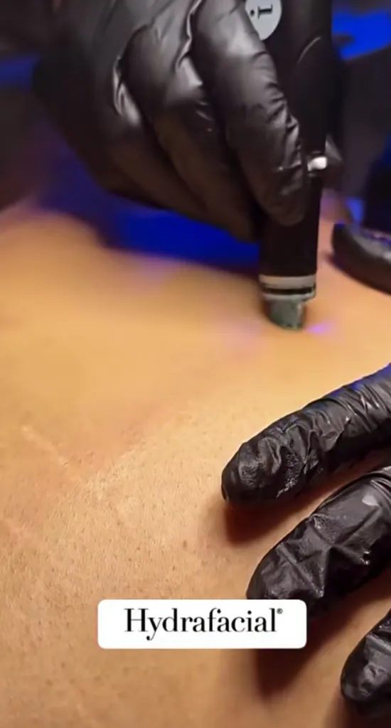 Soins corps Hydrafacial –Toulouse-  Cou, décolleté, fessiers et kératose pilaire chez Mage Studio Toulouse