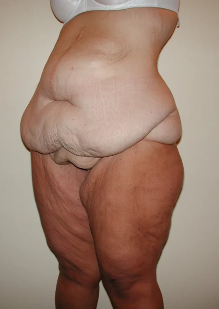 Chirurgie réparatrice extrême à Lyon – Super Bodylift & Remodelage corporel post‑amaigrissement