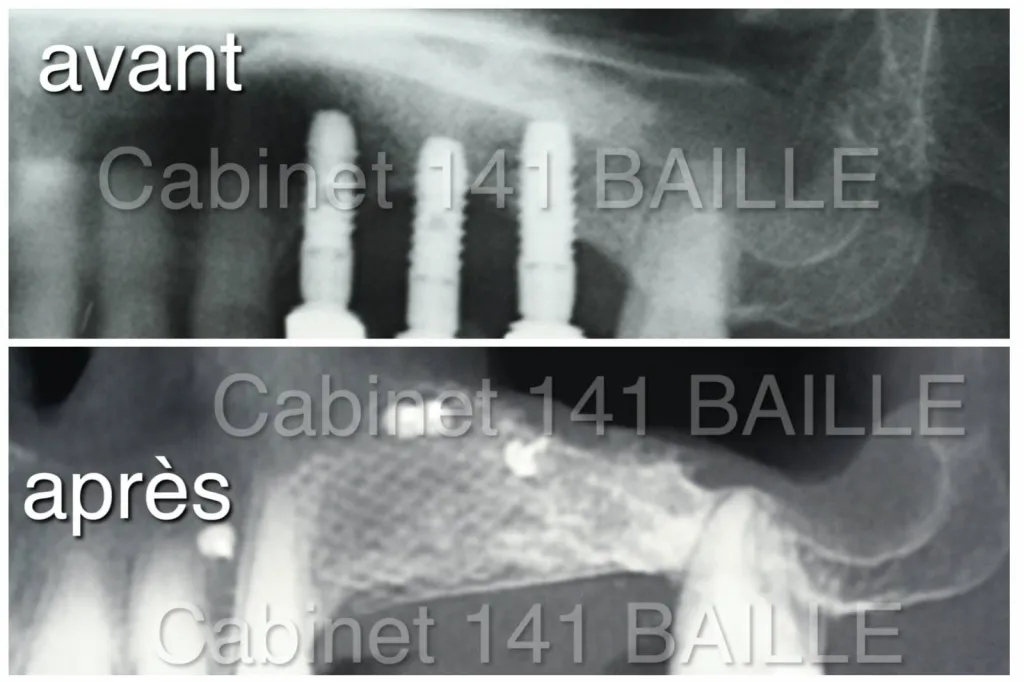 ROG avant implant a marseille